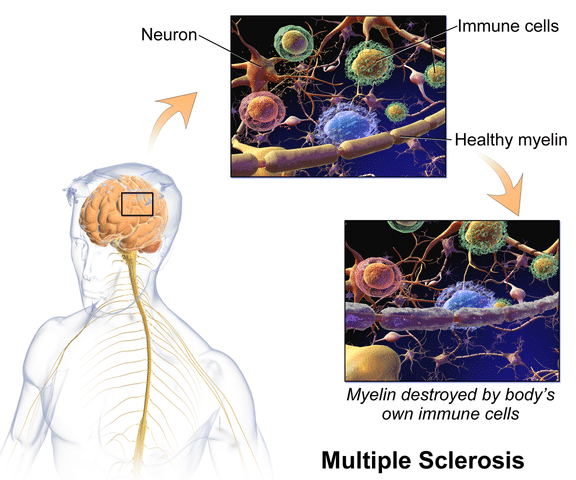 Support through Multiple Sclerosis